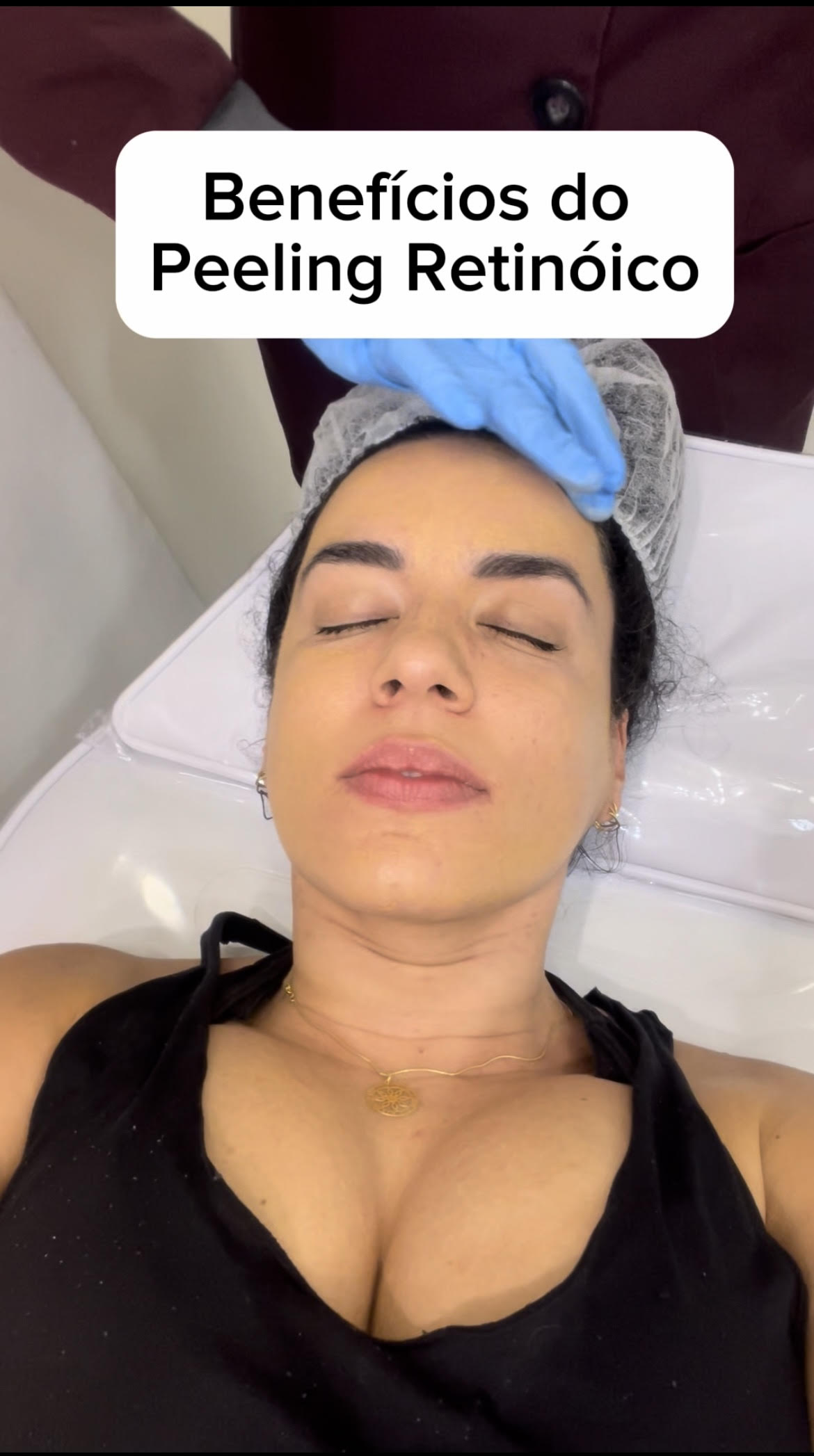 Acne e Melasma: O Peeling Retinóico Pode Ser a Solução?