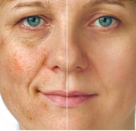 Peeling Retinóico vs. Outros Peelings: Qual o Melhor para Você?