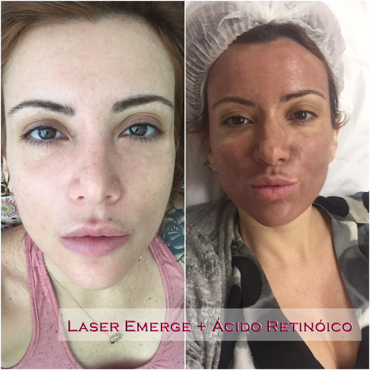 Mitos e Verdades sobre o Pós-Peeling de Ácido Retinóico