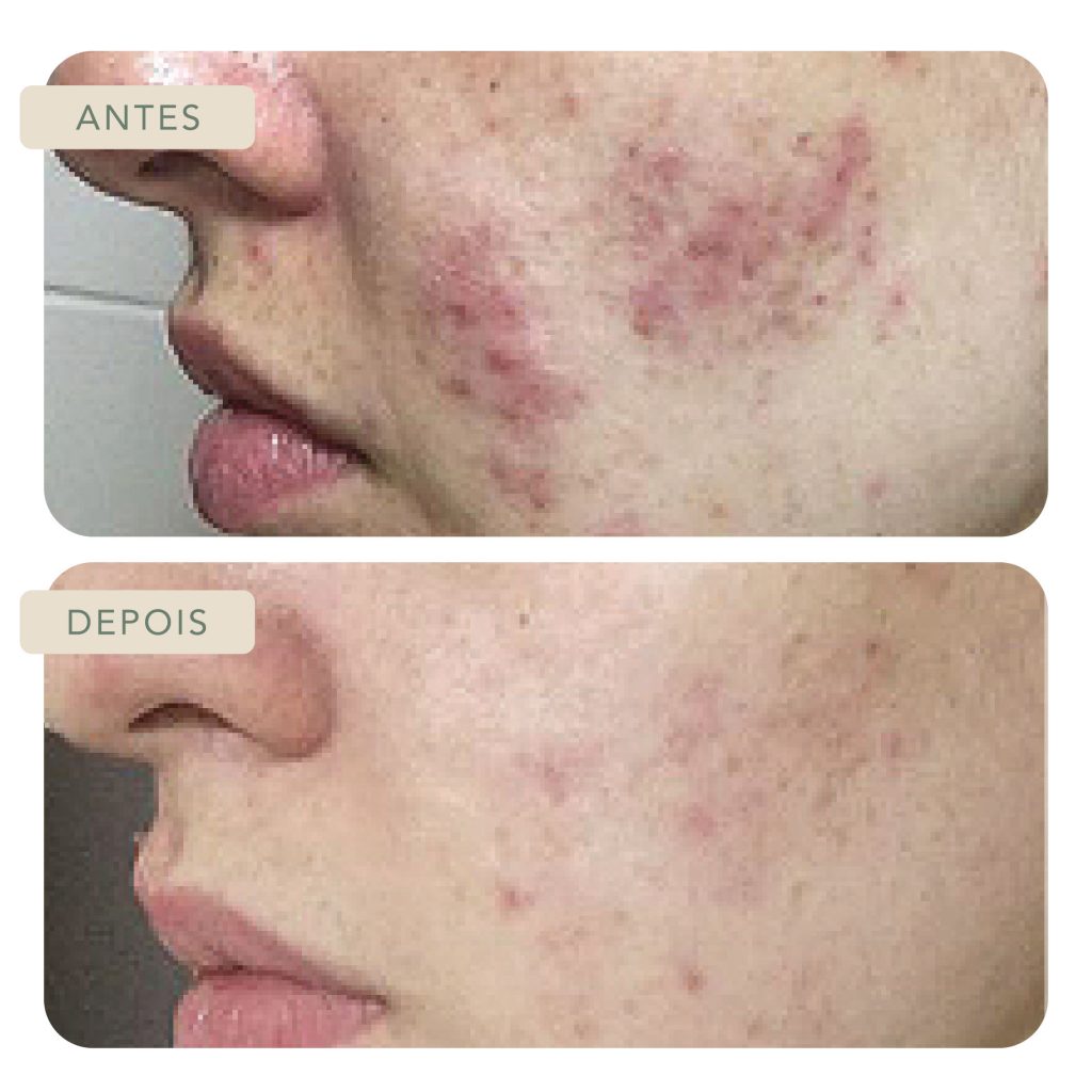 Efeitos Do Peeling De Ácido Retinóico