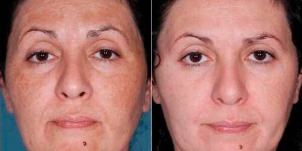 Guia Completo: Peeling de Ácido Retinóico para Iniciantes
