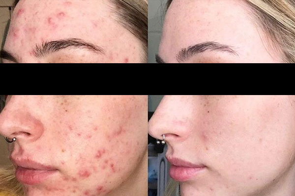 Como Maximizar os Resultados do Peeling Retinóico: Dicas Essenciais