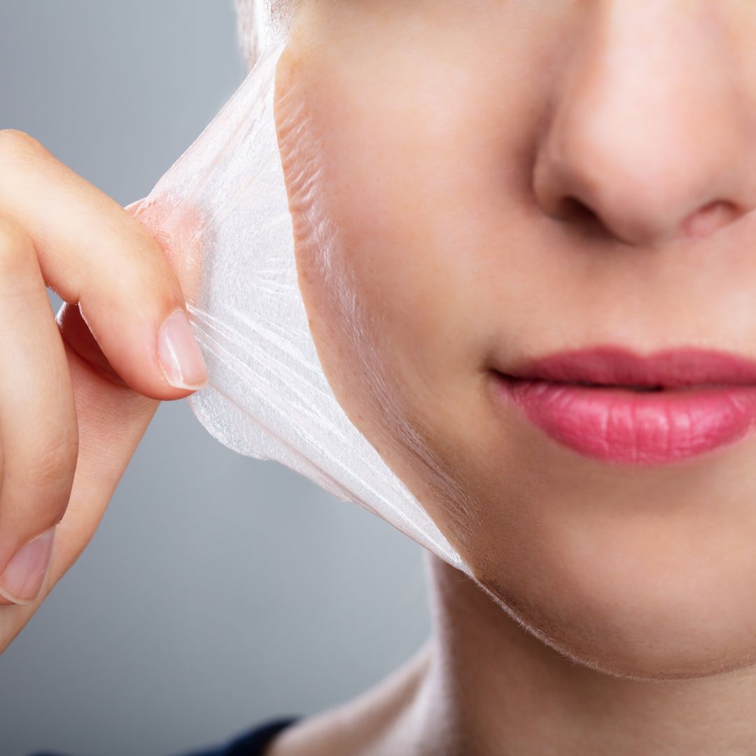 esfoliação química