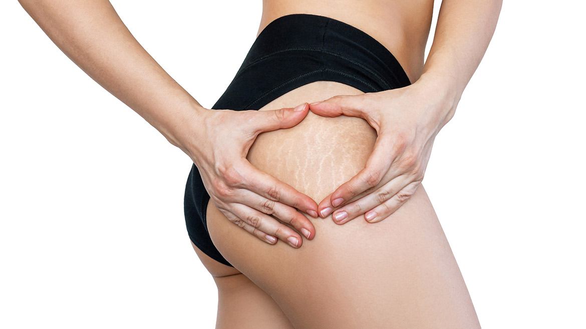 10 Dicas Infalíveis para Prevenir Estrias Durante a Gravidez