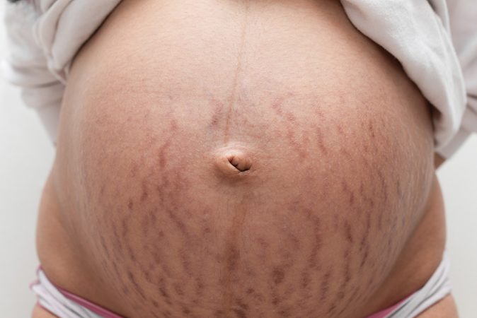 Estrias Vermelhas vs. Brancas: Entenda as Diferenças e Como Tratá-las