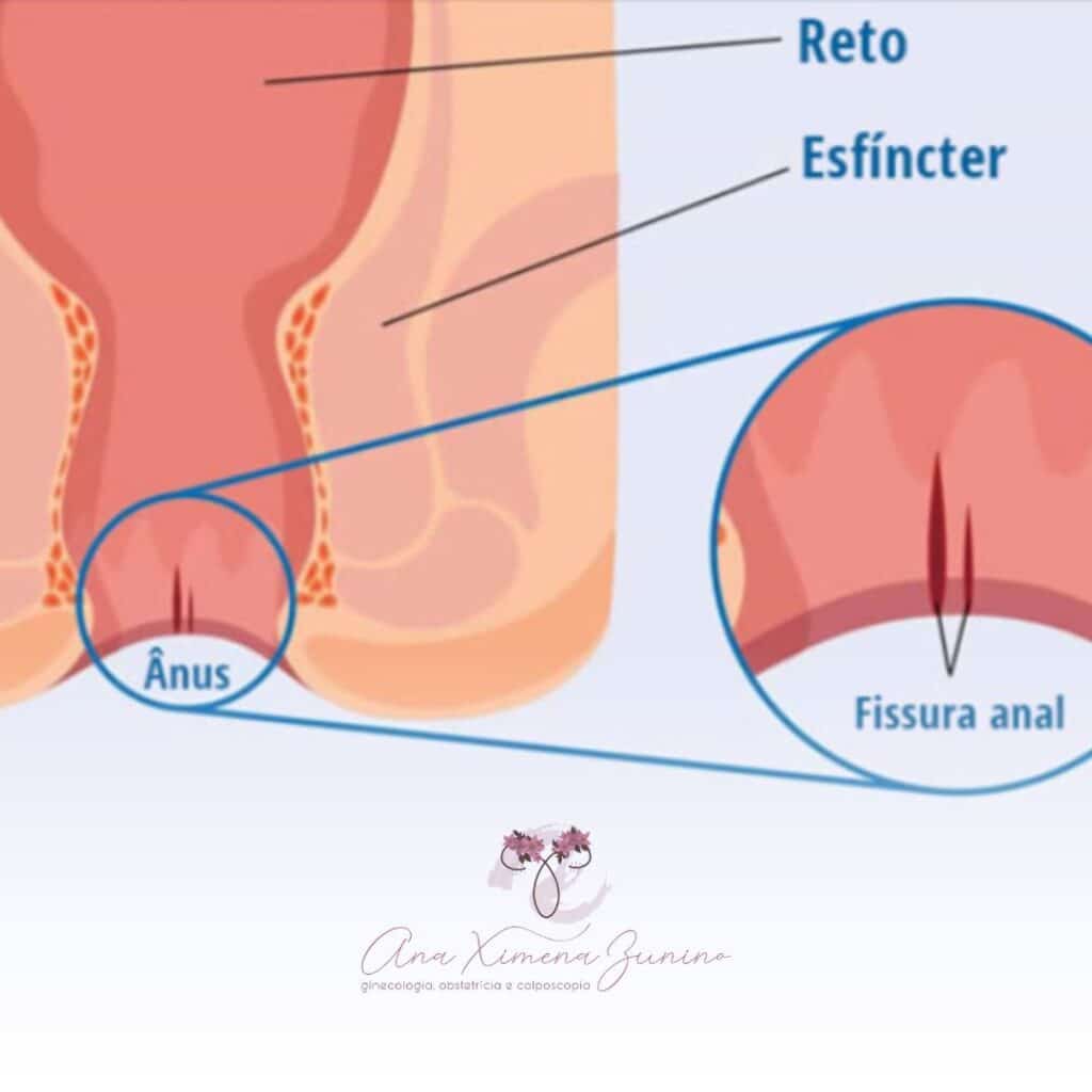 fissuras na vagina