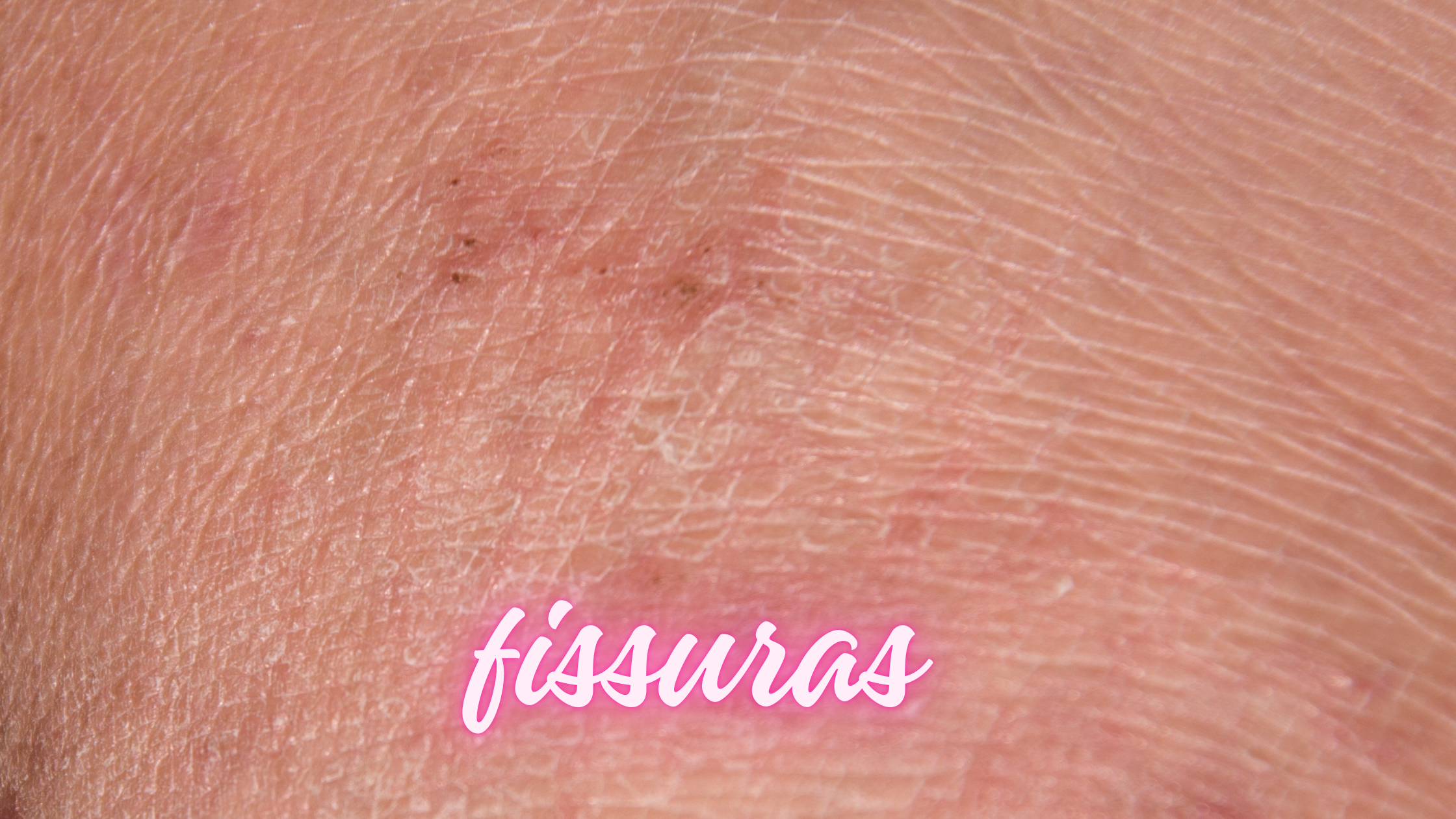 Candidíase e Fissuras Vaginais: Entenda a Conexão e o Tratamento Adequado