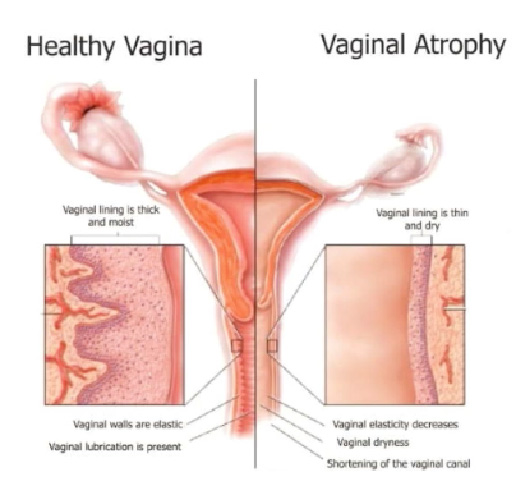 Fissuras Vaginais Recorrentes: Quando se Preocupar e o Que Investigar