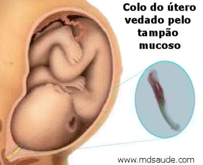 Vaginose Bacteriana na Gravidez: Sintomas