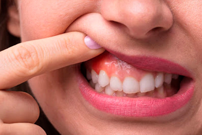 Diferença entre gengivite e periodontite: entenda as fases da doença