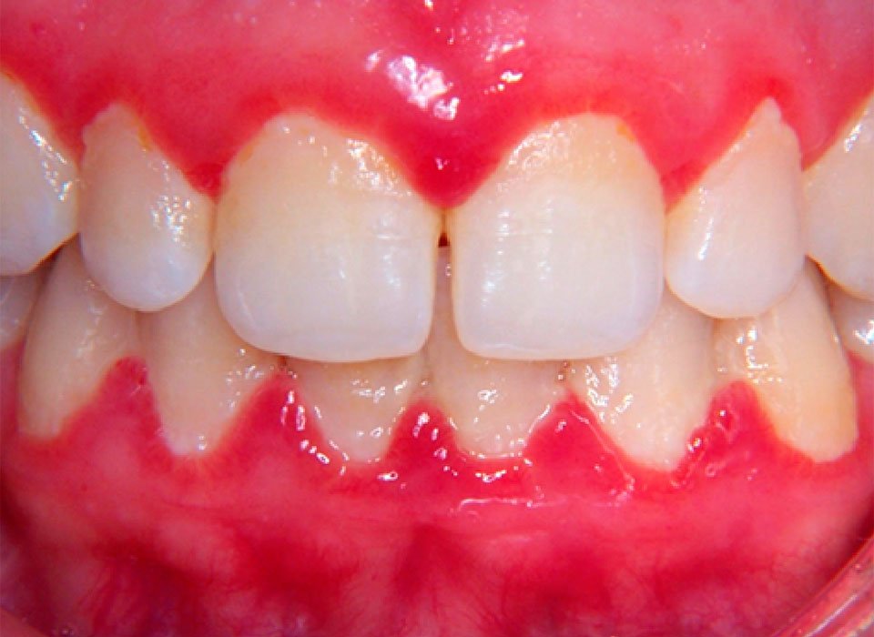Enxaguante bucal funciona contra gengivite? Mitos e verdades