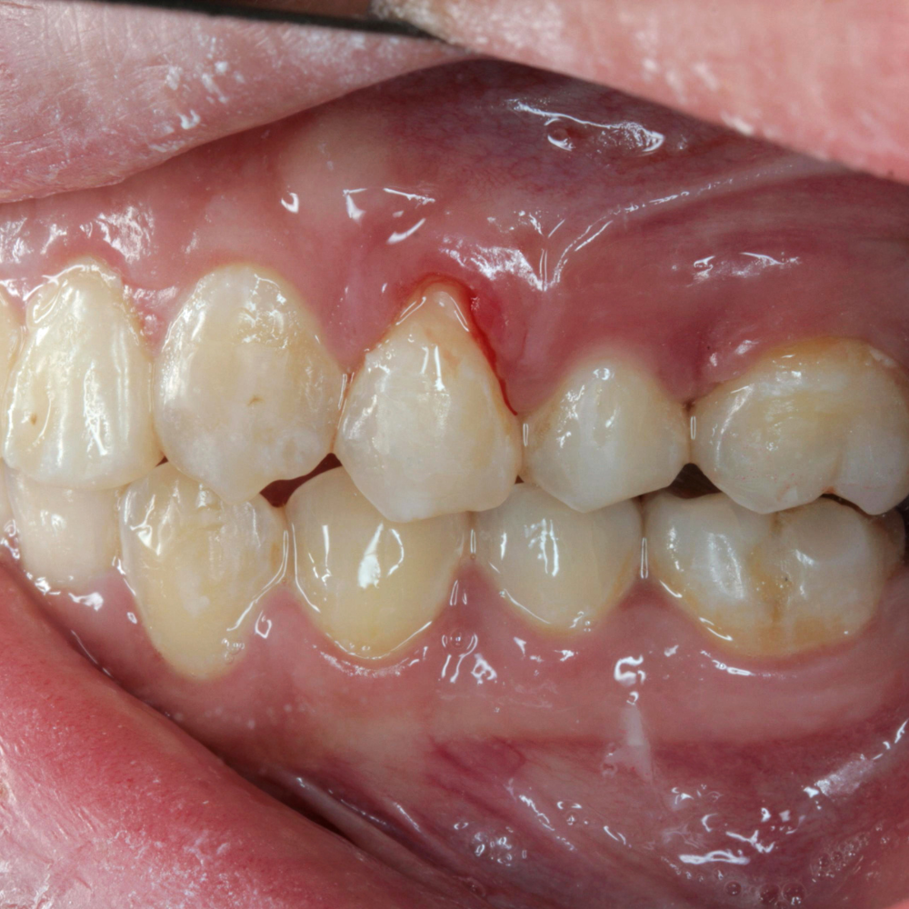 Enxaguante bucal funciona contra gengivite? Mitos e verdades