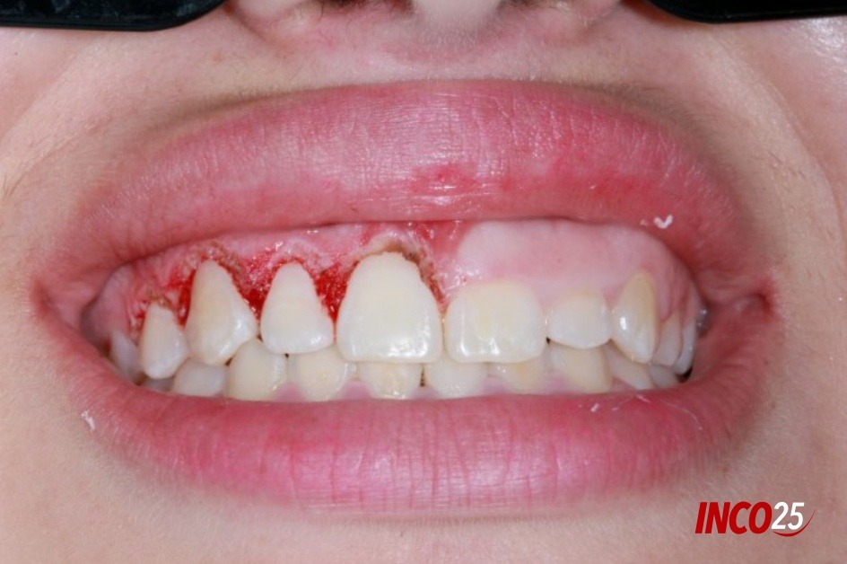 Como identificar os primeiros sinais de gengivite