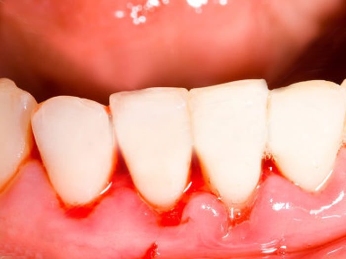 O papel da higiene bucal na prevenção da gengivite