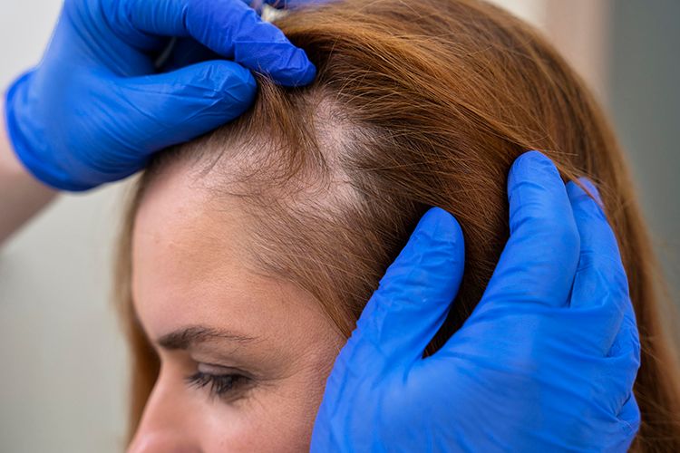 Diferença entre oleosidade hormonal e oleosidade por higiene capilar