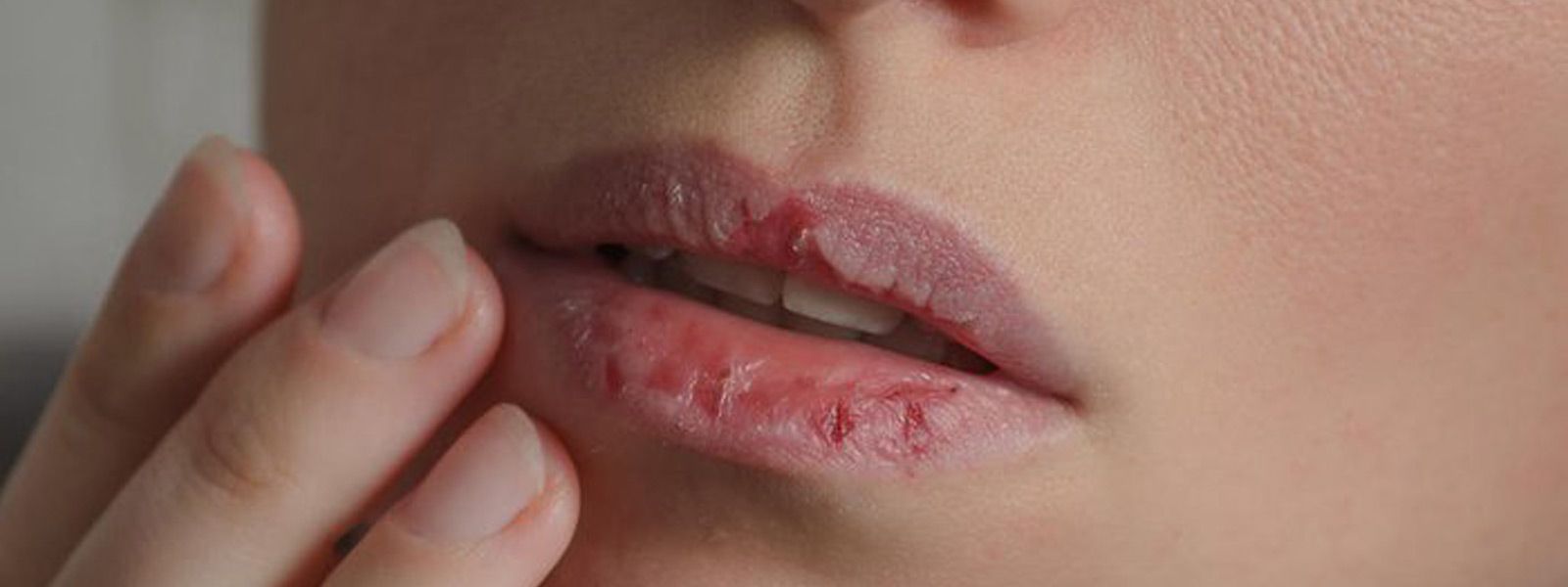 labios ressecados e rachados