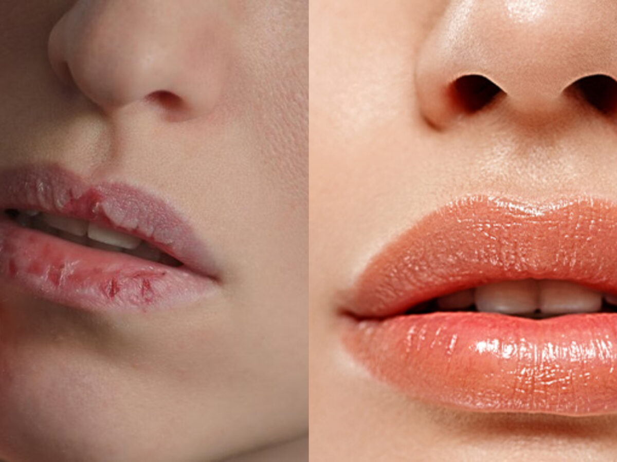 labios ressecados e rachados