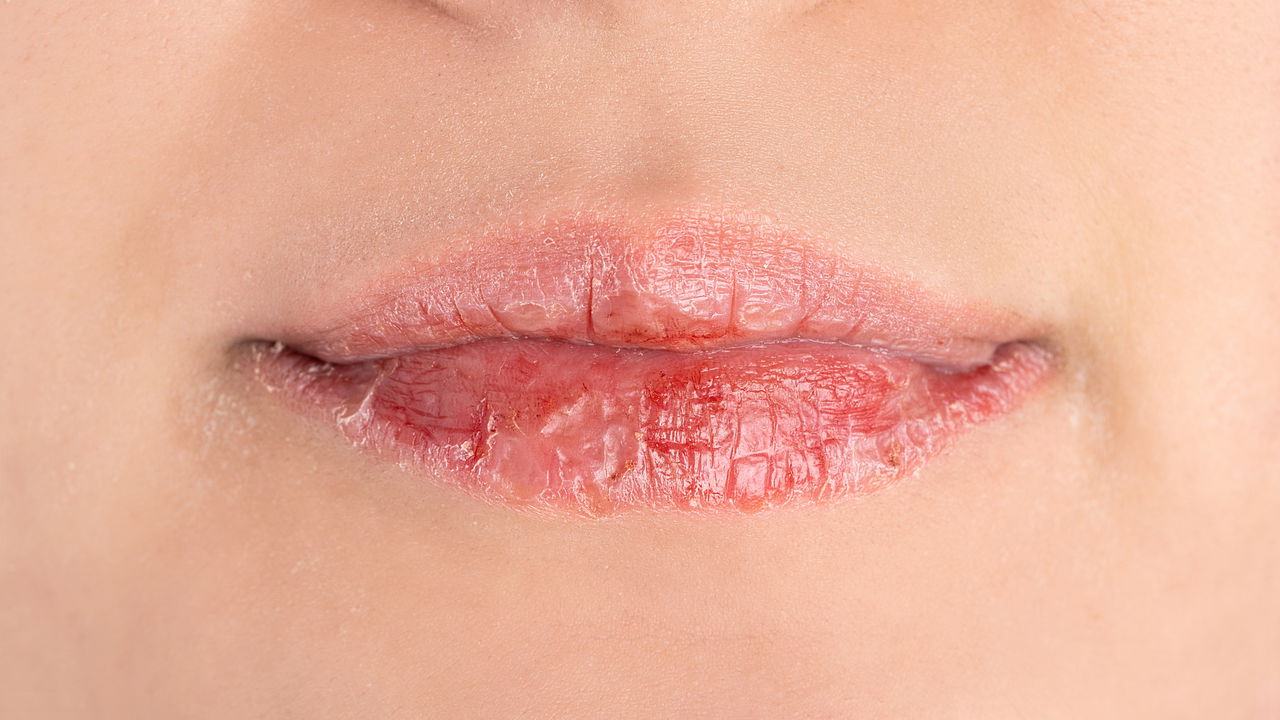 5 ideias de títulos:
1. Lábios Ressecados: Guia Completo de Causas e Tratamentos Eficazes
2. Os Melhores Ingredientes para Hidratar Lábios Rachados
3. Como Evitar Lamber os Lábios e Outros Hábitos Prejudiciais
4. Quando Procurar um Dermatologista para Problemas Labiais
5. Receitas Caseiras e Dicas Naturais para Lábios Saudáveis