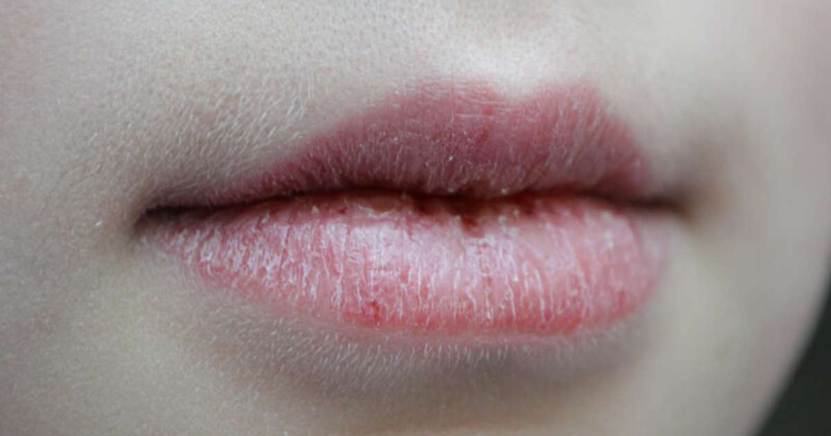 labios ressecados e rachados
