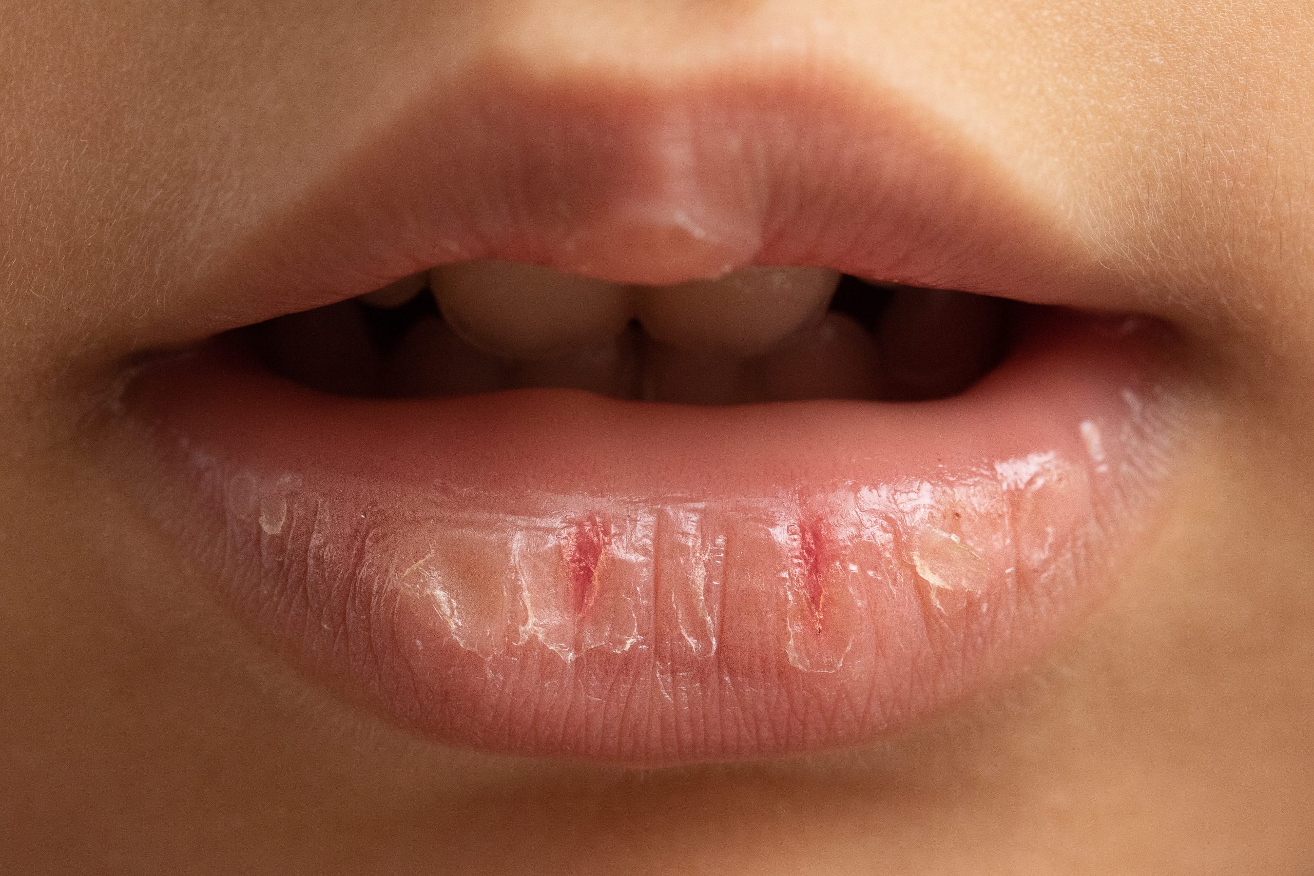 labios ressecados e rachados