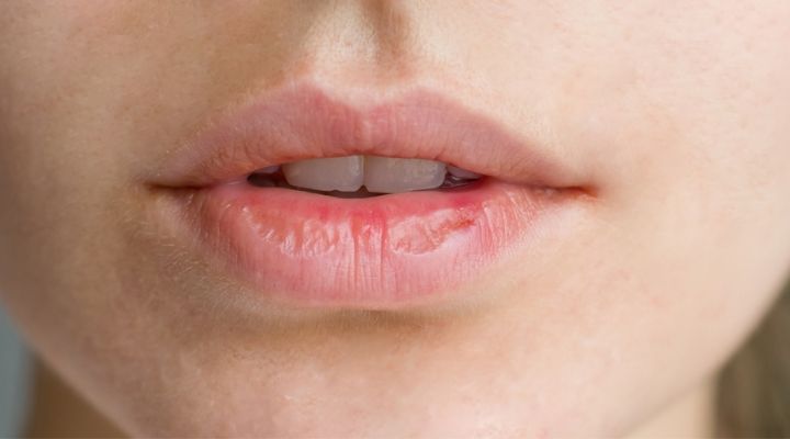labios ressecados e rachados