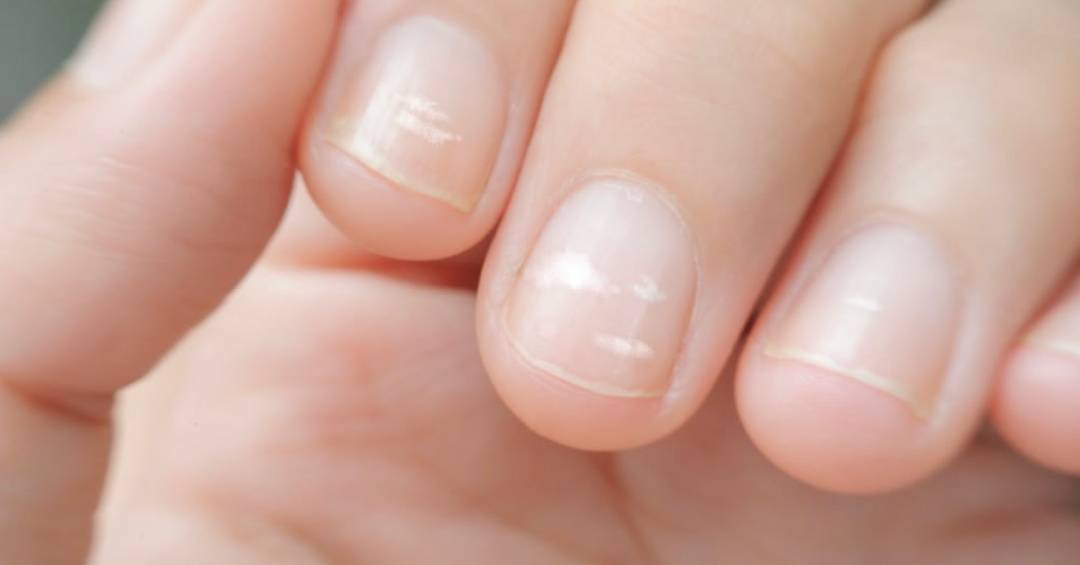 como tirar manchas brancas das unhas naturalmente