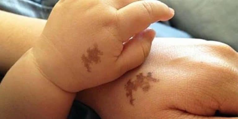 manchas de nascença