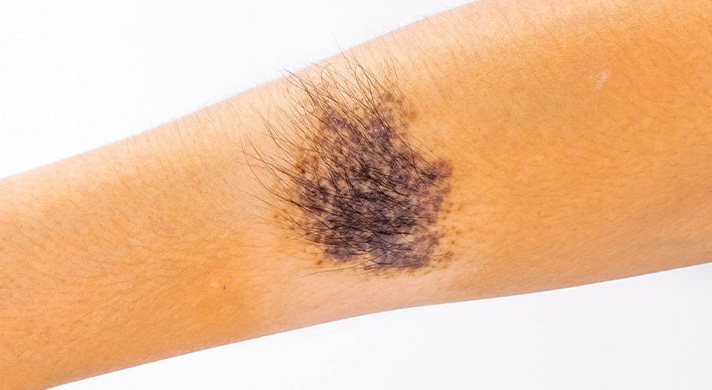 Manchas Café com Leite: Sinais de Alerta e Diagnóstico