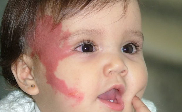 Leucodermia Congênita: Causas e Cuidados