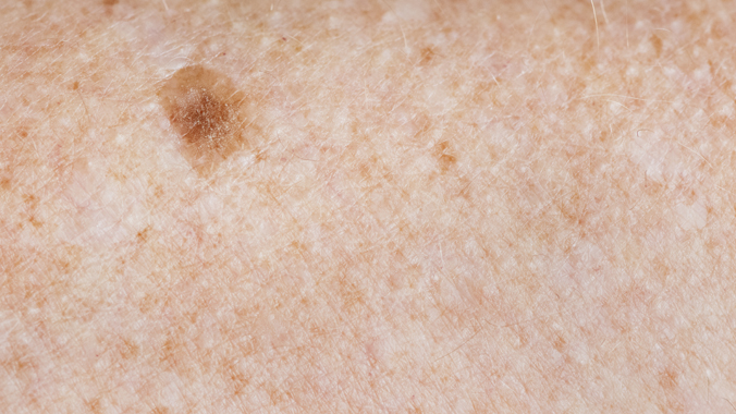 A Importância do Acompanhamento Médico para Manchas de Nascença