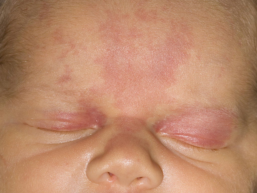 manchas de nascença