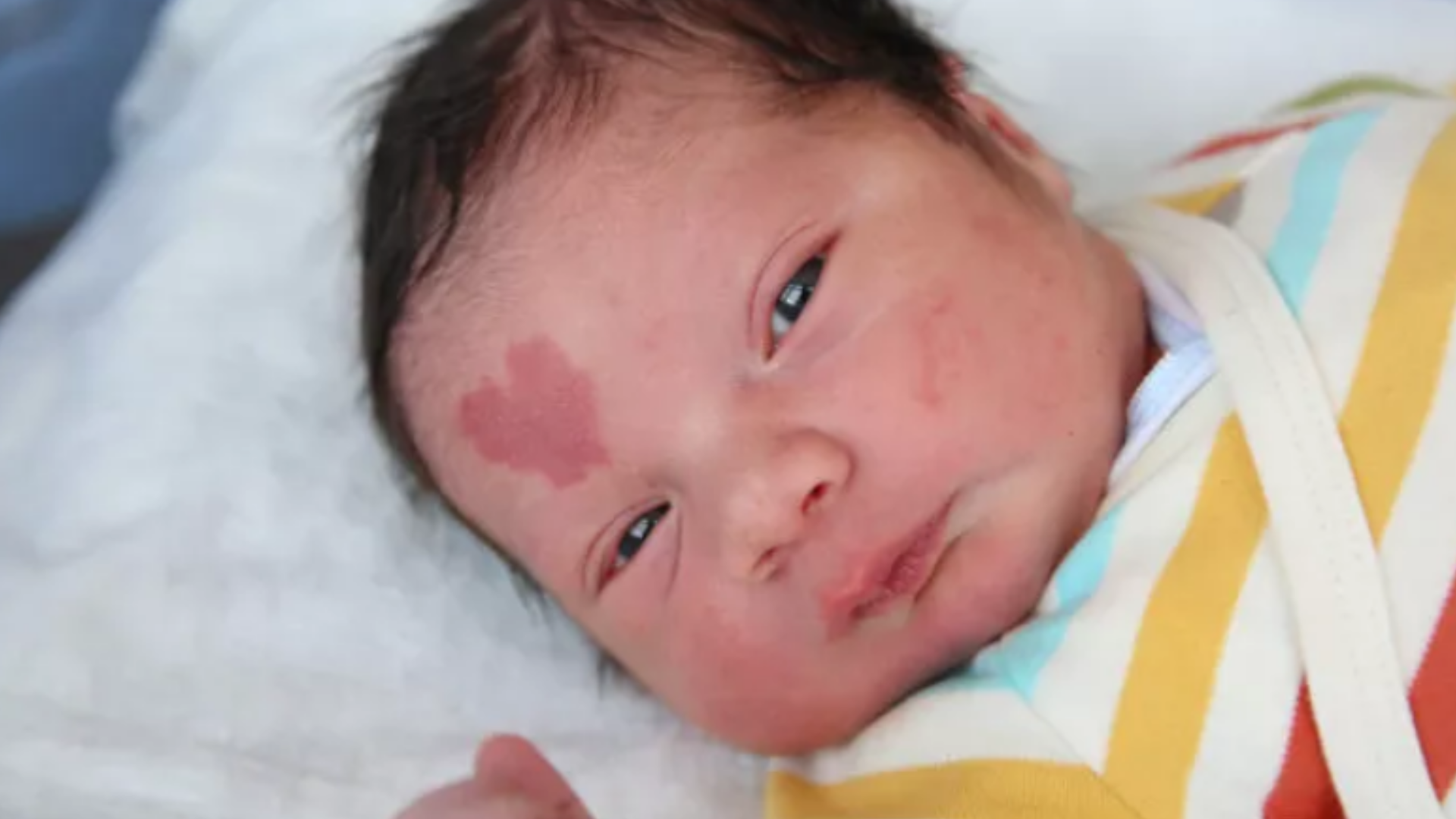 O que é Hemangioma Morango e Como Tratar?