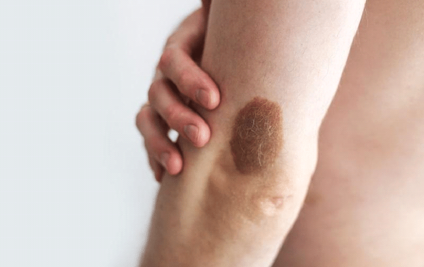 Manchas Café com Leite: Sinais de Alerta e Diagnóstico