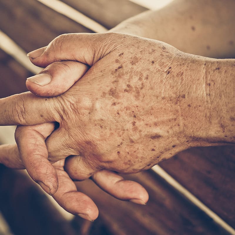 como tratar lentigos solares
