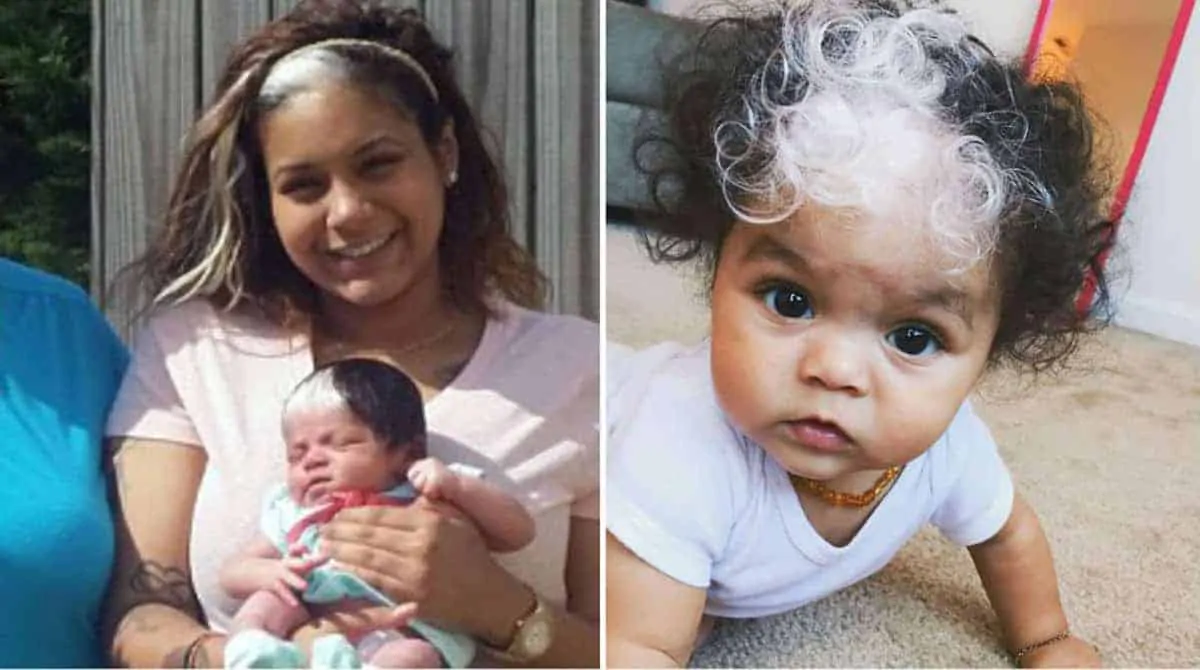 Piebaldismo e Poliose: Entenda as Causas Naturais da Mecha Branca no Cabelo