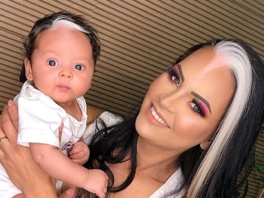 Piebaldismo e Poliose: Entenda as Causas Naturais da Mecha Branca no Cabelo