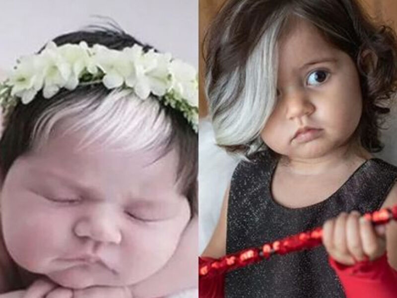 Piebaldismo e Poliose: Entenda as Causas Naturais da Mecha Branca no Cabelo