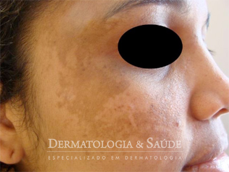 melasma na gravidez