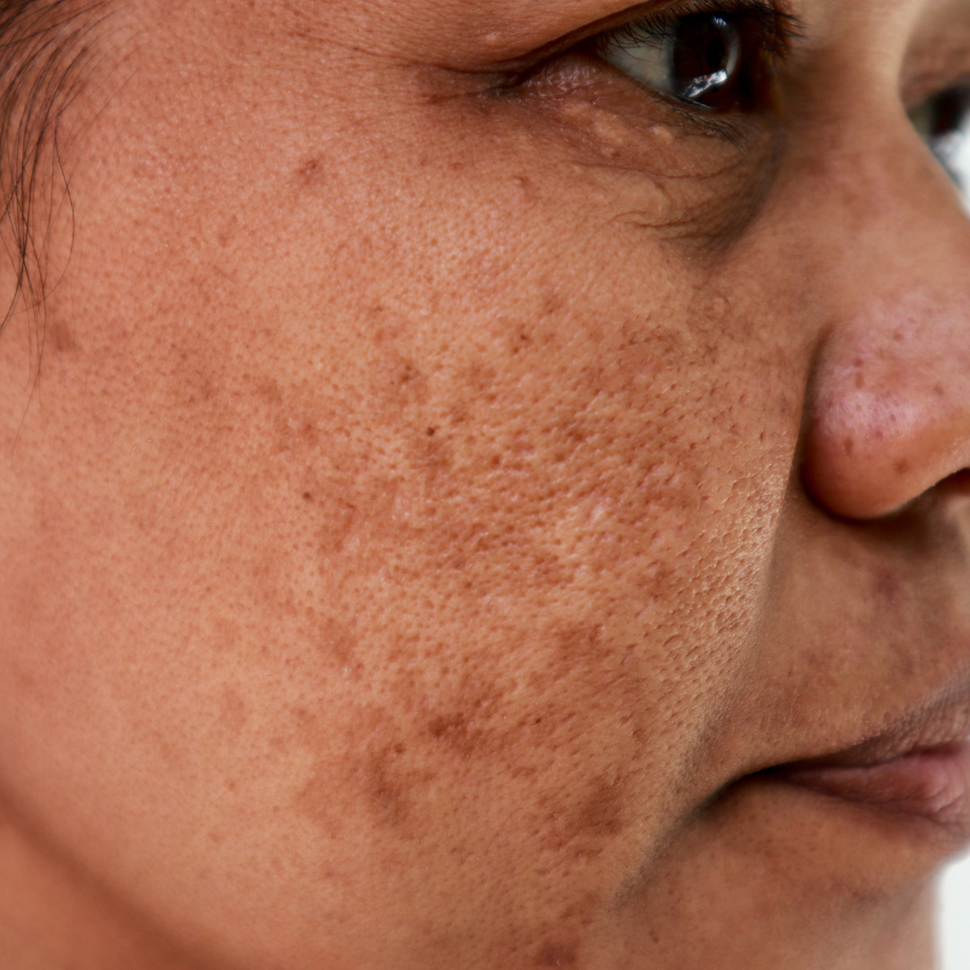 Os melhores ativos clareadores permitidos na gravidez