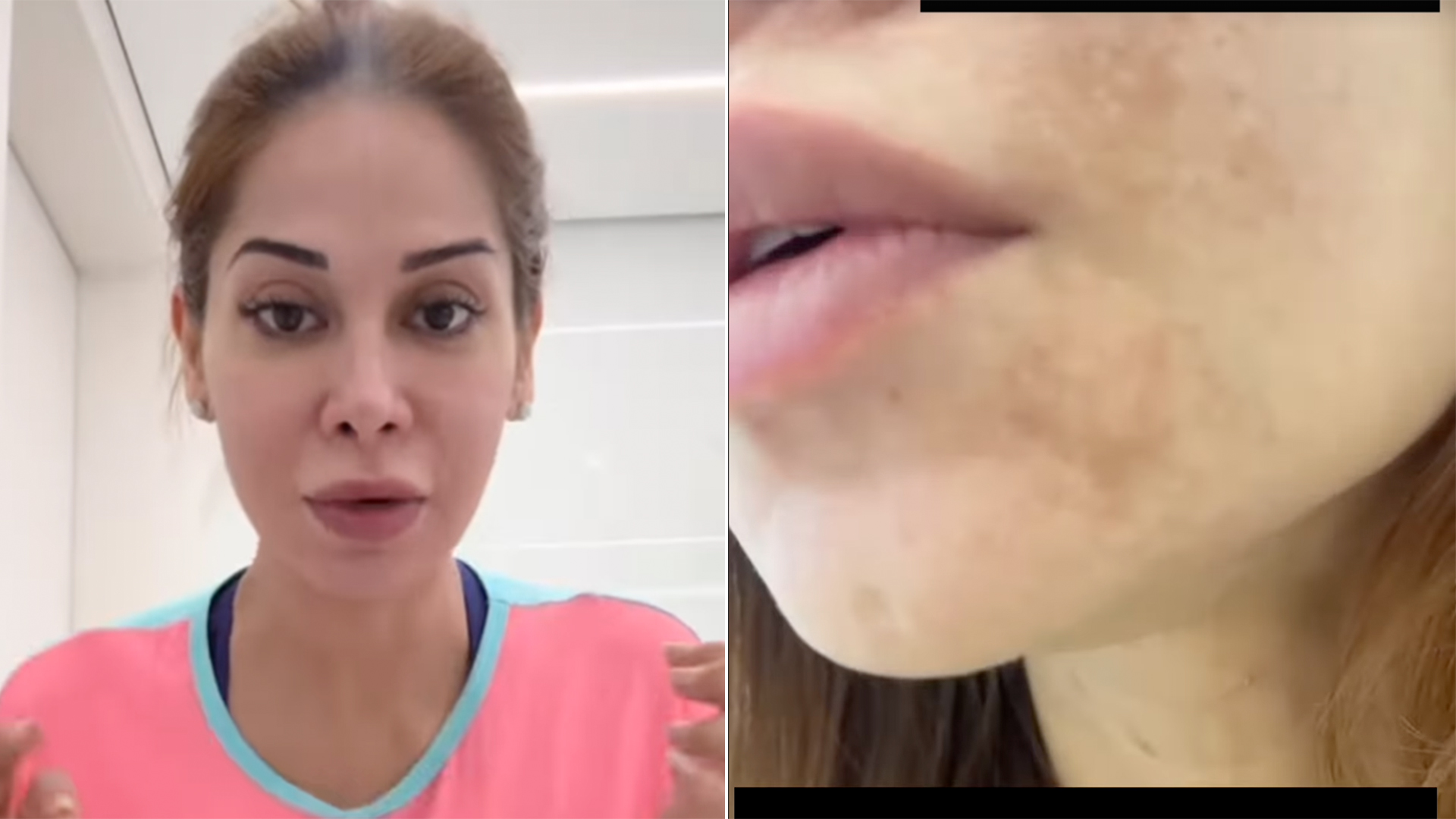 Diferença entre melasma e outras manchas na gravidez