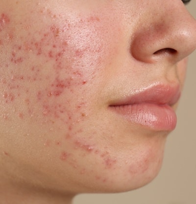 melhor pomada para acne e manchas