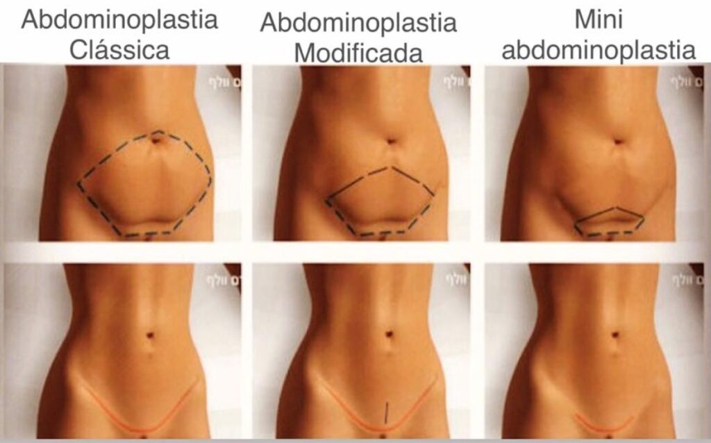 Mini Lipo x Lipoaspiração Tradicional: Qual a Melhor Opção para Você?