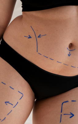 Mini Lipo x Lipoaspiração Tradicional: Qual a Melhor Opção para Você?