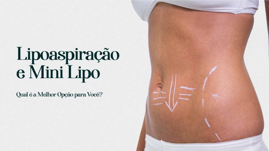 Riscos e Benefícios da Mini Lipo: Tudo o Que Você Precisa Saber Antes de Decidir.
