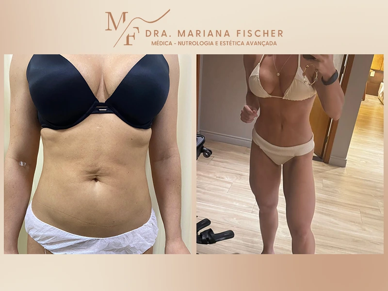 Quanto Custa uma Mini Lipo em 2026? Guia Completo de Preços e Fatores.