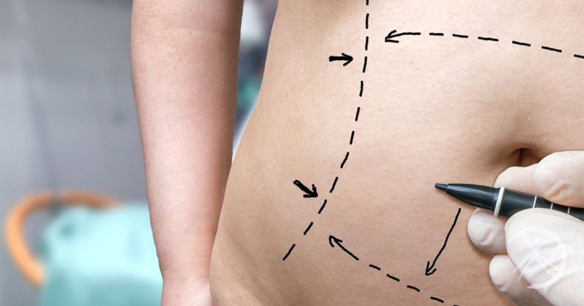 Mini Lipo na Papada e Pochete: Resultados e Indicações para Áreas Específicas.