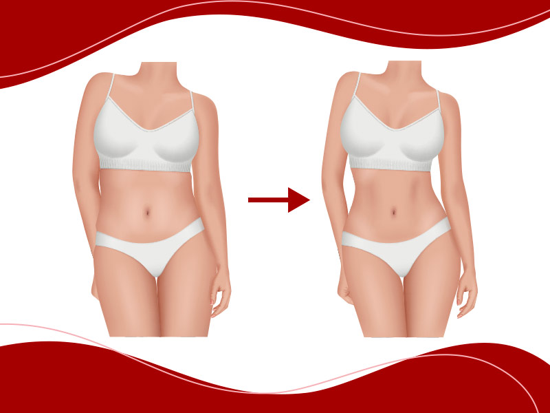 Mini Lipo na Papada e Pochete: Resultados e Indicações para Áreas Específicas.