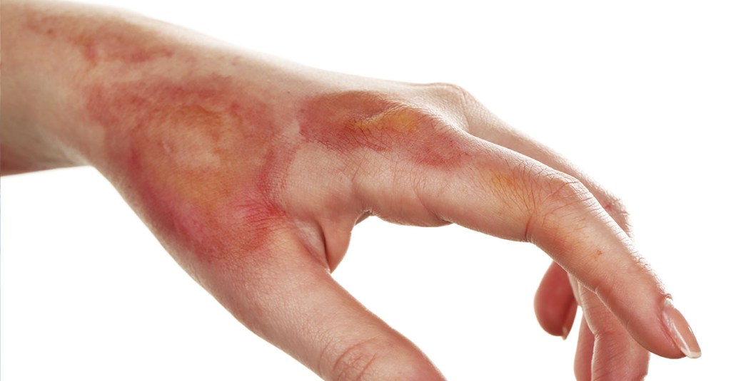 o que é bom pra queimadura