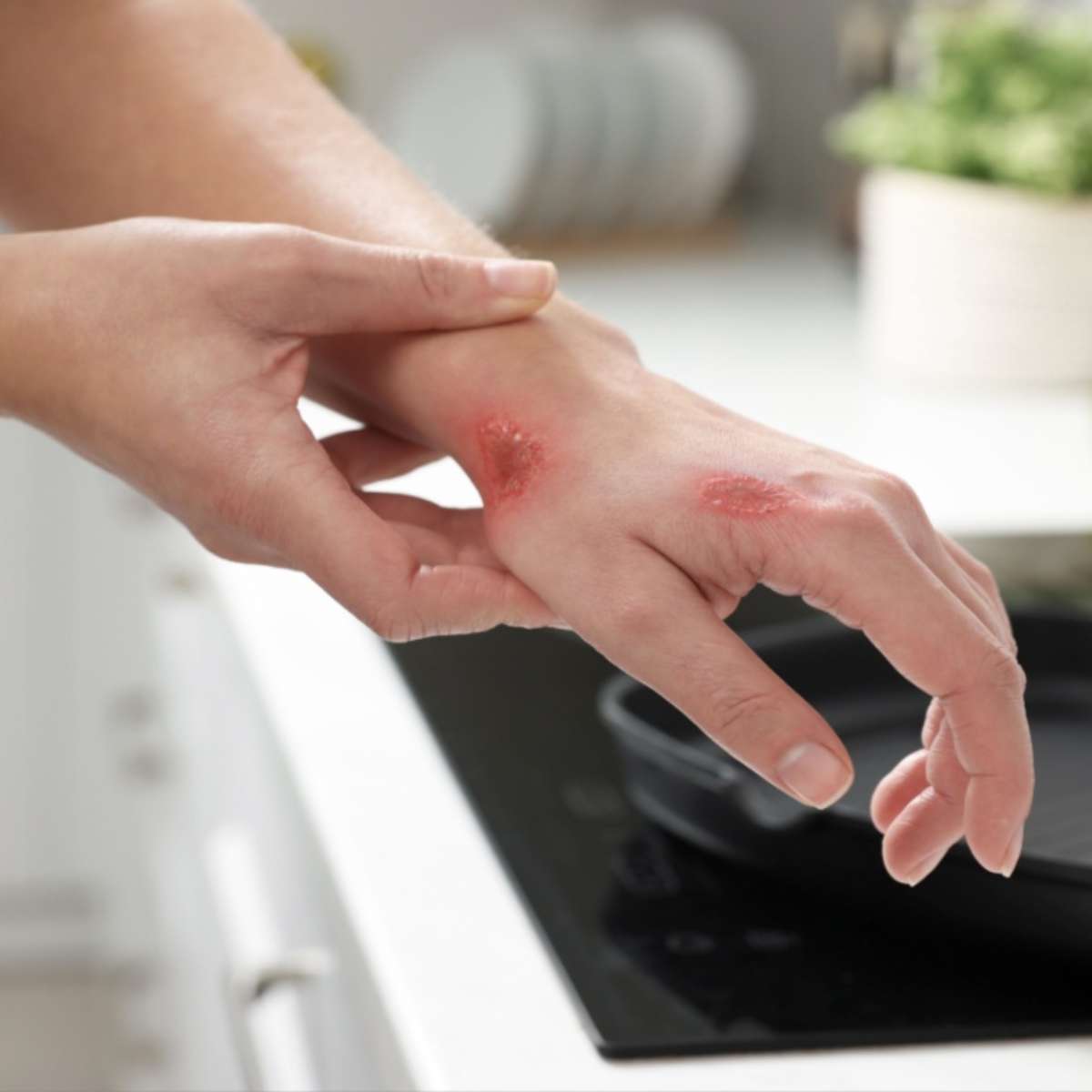 1. Como identificar o grau de uma queimadura.
2. Receitas caseiras para queimaduras: Mitos e Verdades.
3. A importância da hidratação na recuperação de queimaduras.
4. Quando procurar um médico para queimaduras.
5. Cuidados com queimaduras em crianças.