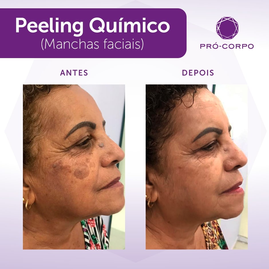 o que é peeling